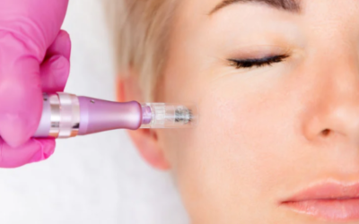 Microneedling: to numb or not to numb